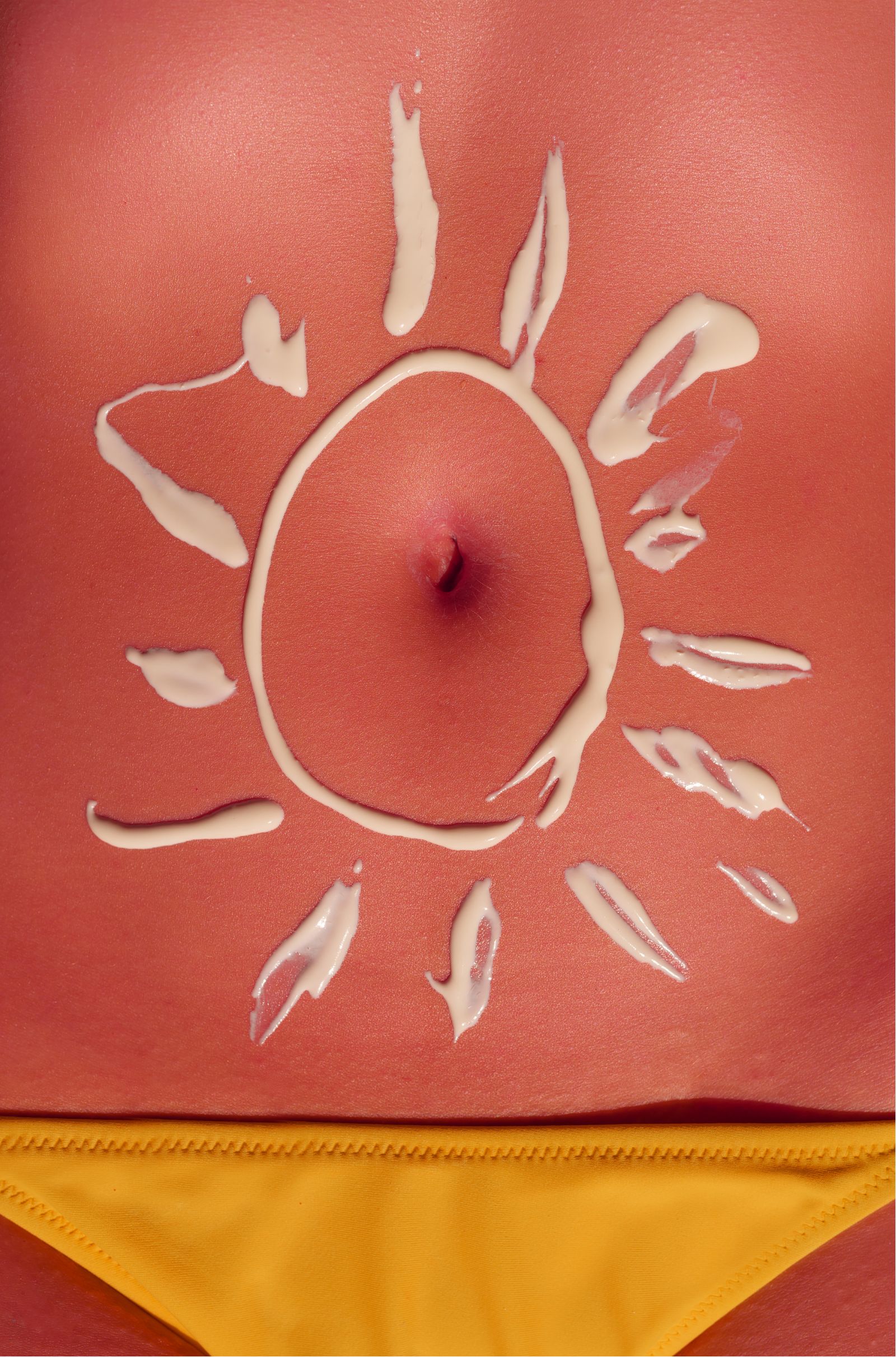 sunburn relief